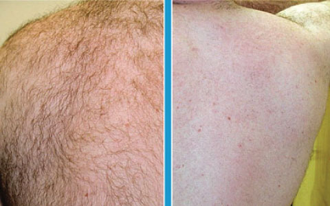 images/samples/480x300/480x300_hair_removal_1.jpg