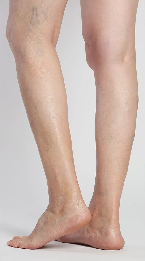 Stage 1: Spider Veins | Joyce Vein & Aesthetic Institute