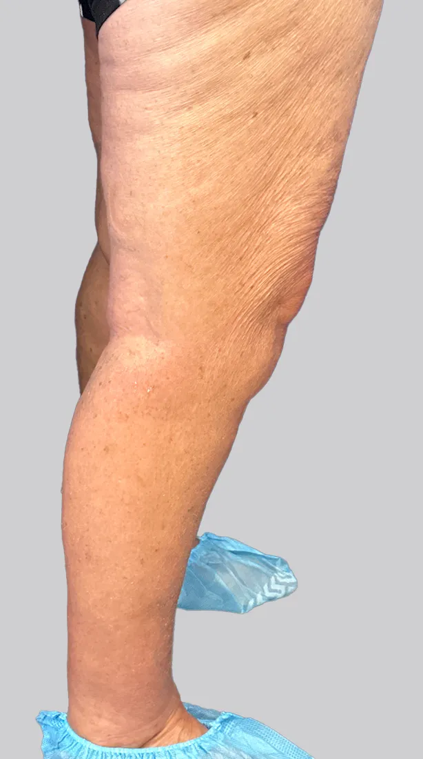Stage 3: Swelling (Edema) | Joyce Vein & Aesthetic Institute
